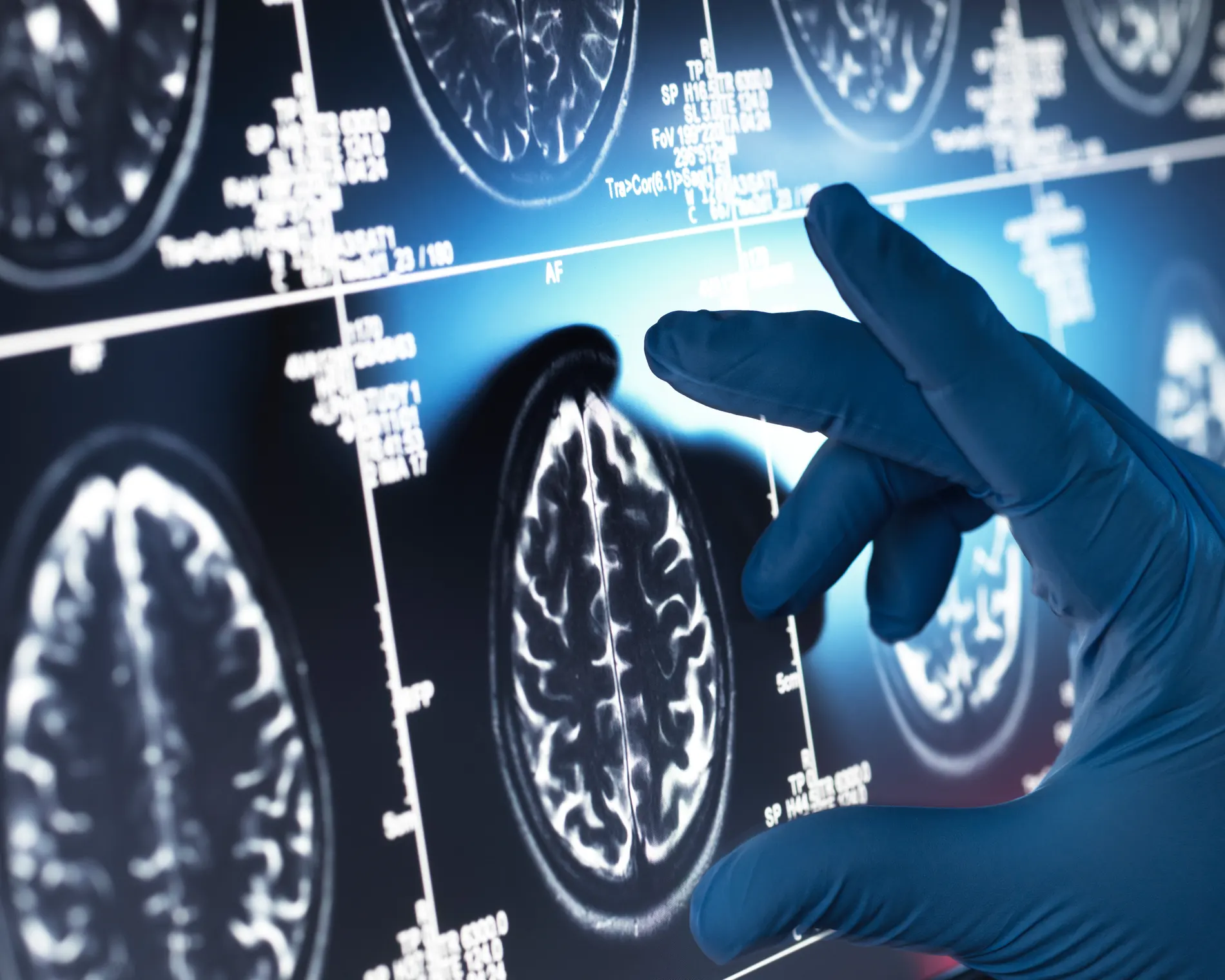 İnceleme sonucuna göre, “‘Oyun değiştirici’ Alzheimer ilaçlarının etkisi ‘önemsiz’”