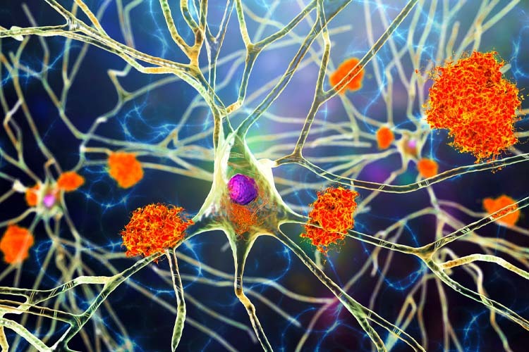 Alzheimer'a karşı mücadelede yeni bir umut